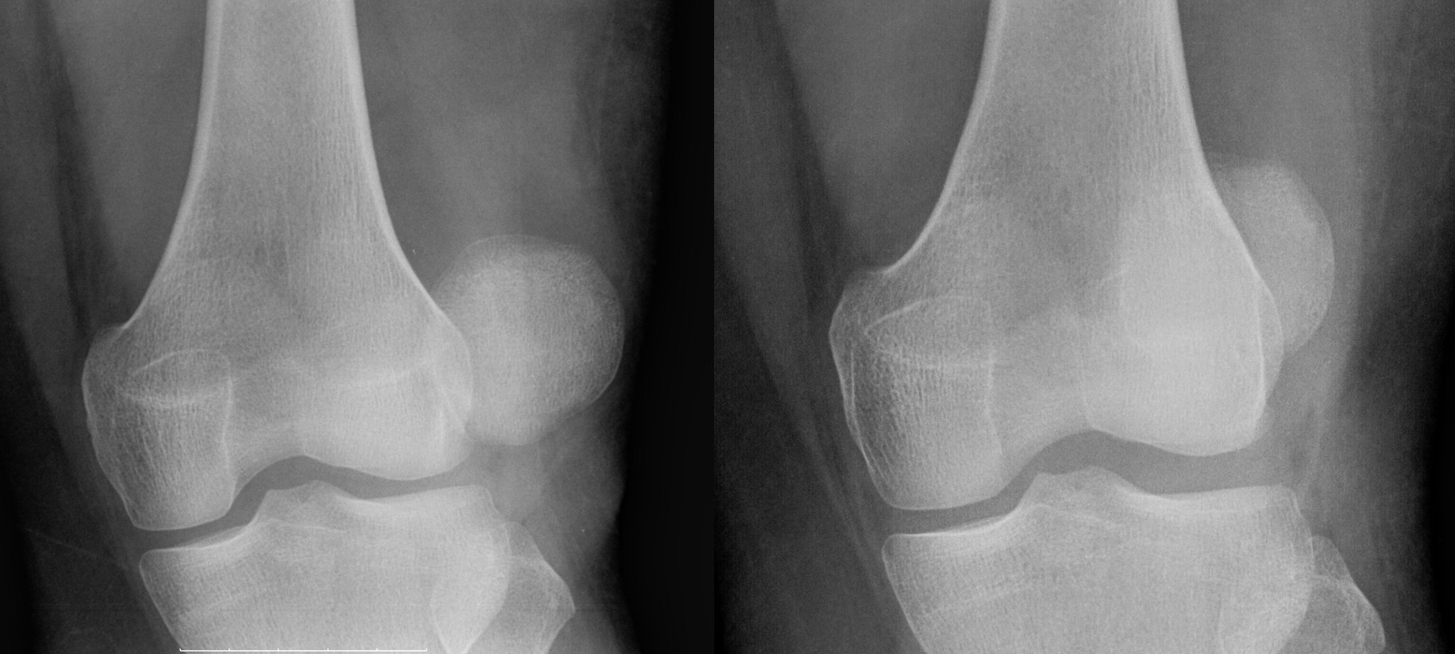 2048px-Patellaluxation luxating patella